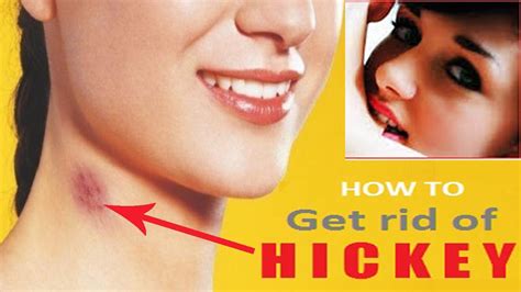 love bite on breast|How to Get Rid of Hickeys: Stages, Love Bite。